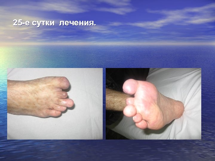 25 -е сутки лечения. 