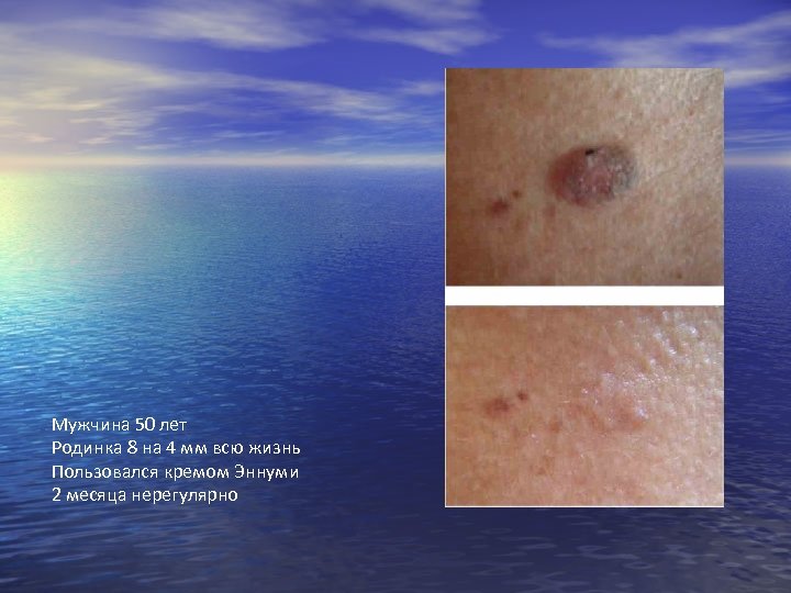 Мужчина 50 лет Родинка 8 на 4 мм всю жизнь Пользовался кремом Эннуми 2