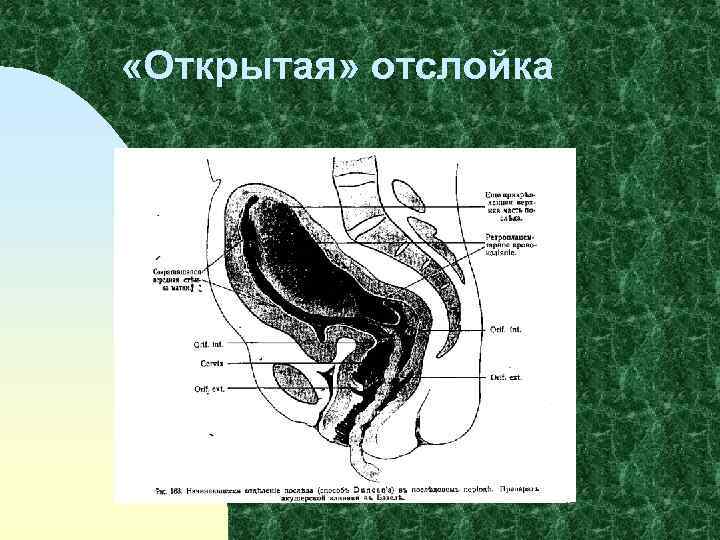  «Открытая» отслойка 