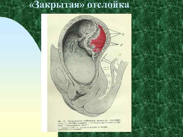  «Закрытая» отслойка 