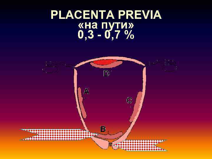 PLACENTA PREVIA «на пути» 0, 3 - 0, 7 % 