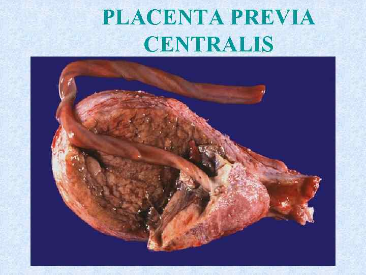 PLACENTA PREVIA CENTRALIS 