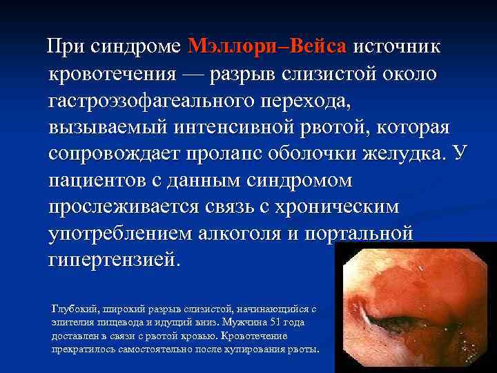 При синдроме Мэллори–Вейса источник кровотечения — разрыв слизистой около гастроэзофагеального перехода, вызываемый интенсивной рвотой,