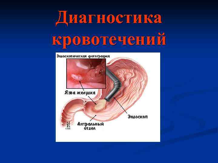 Диагностика кровотечений 