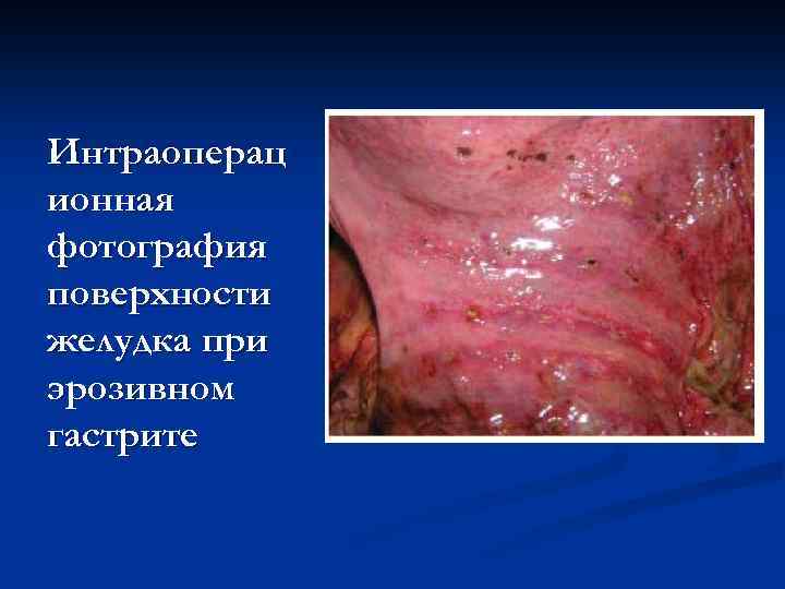 Интраоперац ионная фотография поверхности желудка при эрозивном гастрите 