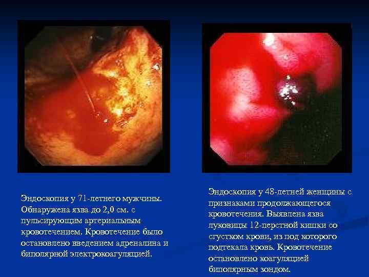 Эндоскопия у 71 -летнего мужчины. Обнаружена язва до 2, 0 см. с пульсирующим артериальным