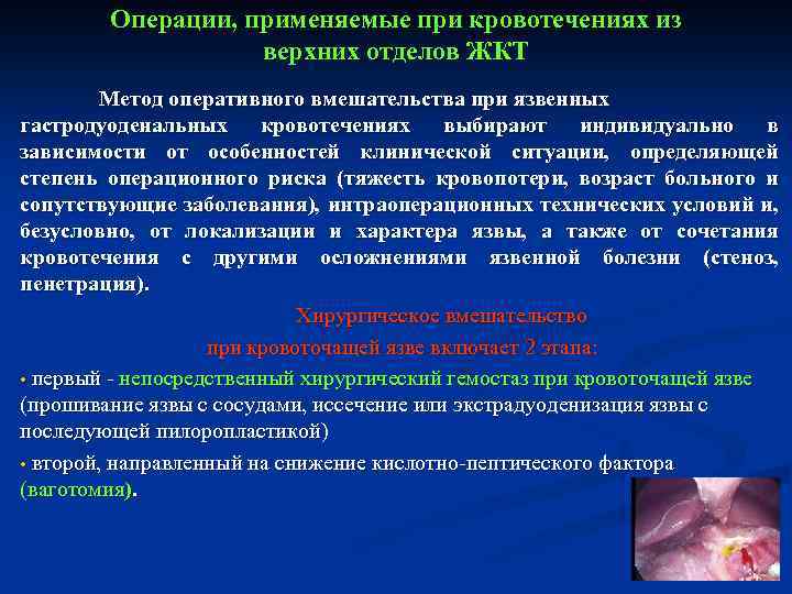 Желудочные кровотечения тест нмо. Операции при желудочно кишечном кровотечении. Показания к операции при желудочно-кишечном кровотечении. Операции при желудочном кровотечении. Операции при гастродуоденальных кровотечениях.