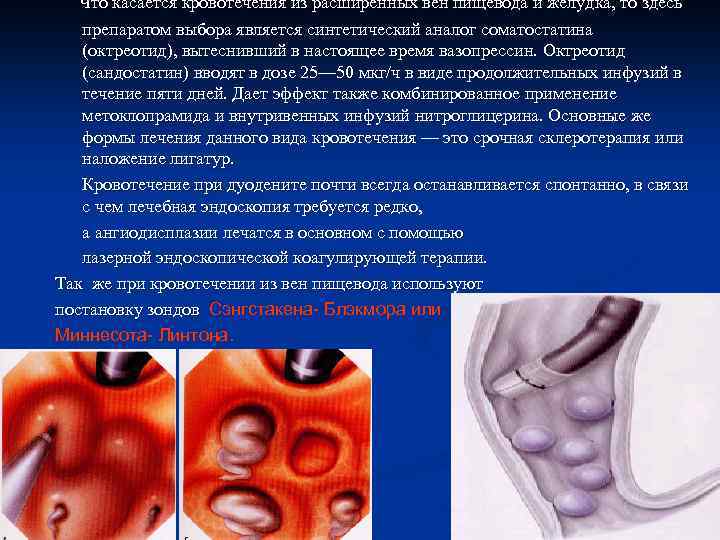 Что касается кровотечения из расширенных вен пищевода и желудка, то здесь препаратом выбора является