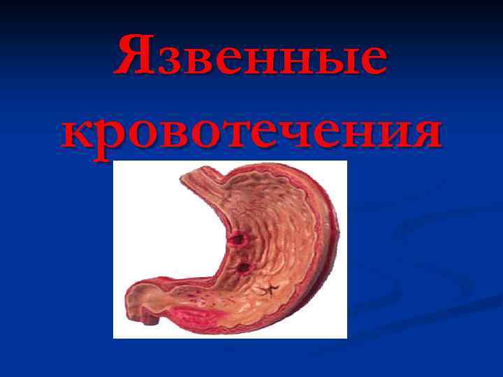 Язвенные кровотечения 