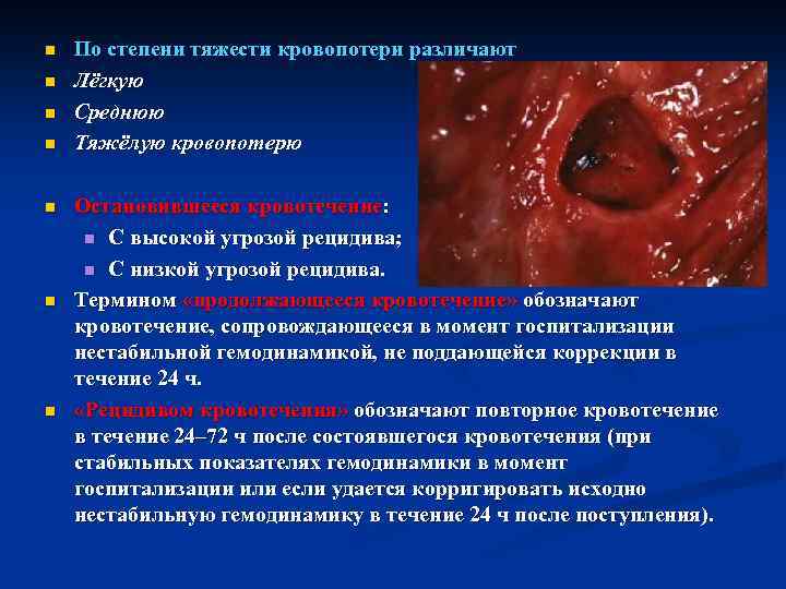 n n n n По степени тяжести кровопотери различают Лёгкую Среднюю Тяжёлую кровопотерю Остановившееся