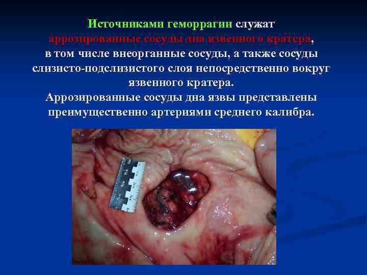 Источниками геморрагии служат аррозированные сосуды дна язвенного кратера, в том числе внеорганные сосуды, а