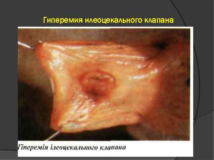 Гиперемия илеоцекального клапана 