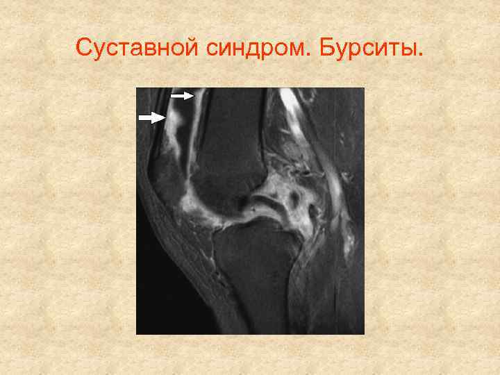 Суставной синдром. Бурситы. 