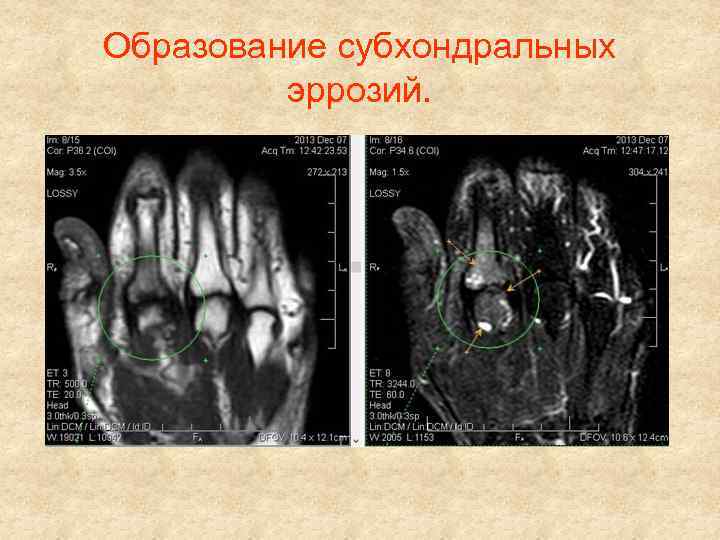 Образование субхондральных эррозий. 