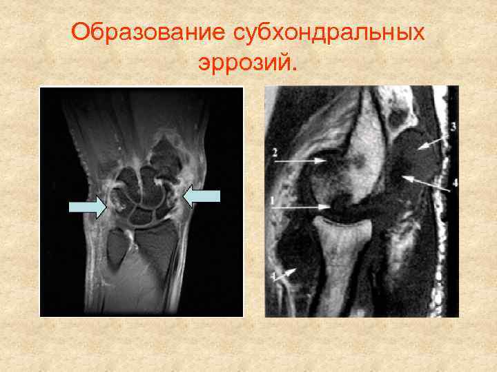 Образование субхондральных эррозий. 