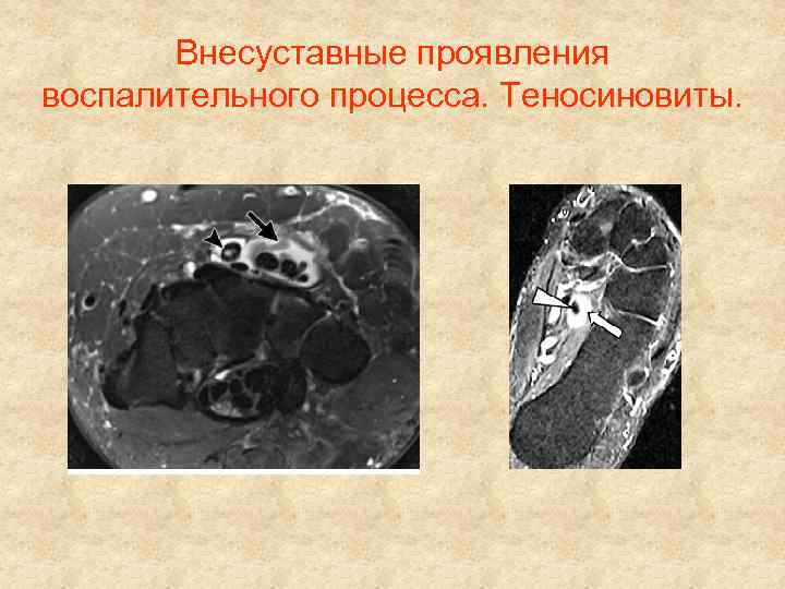 Внесуставные проявления воспалительного процесса. Теносиновиты. 