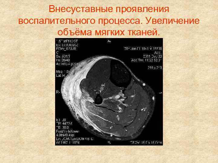 Внесуставные проявления воспалительного процесса. Увеличение объёма мягких тканей. 