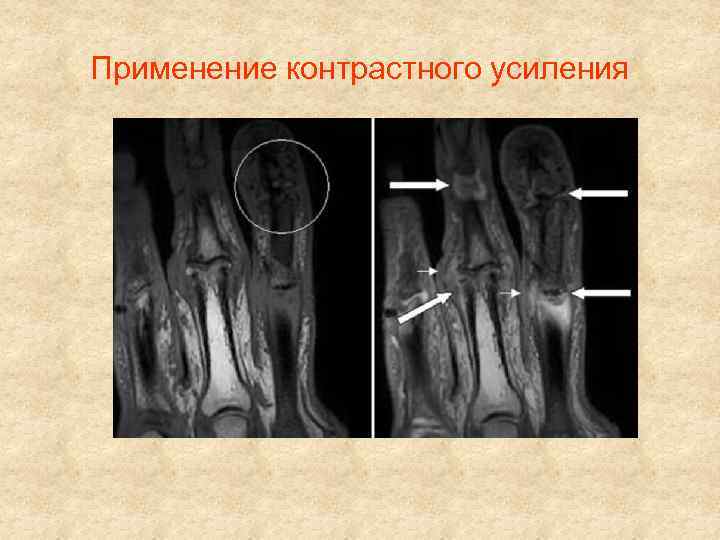 Применение контрастного усиления 