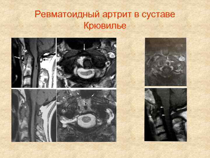 Ревматоидный артрит в суставе Крювилье 