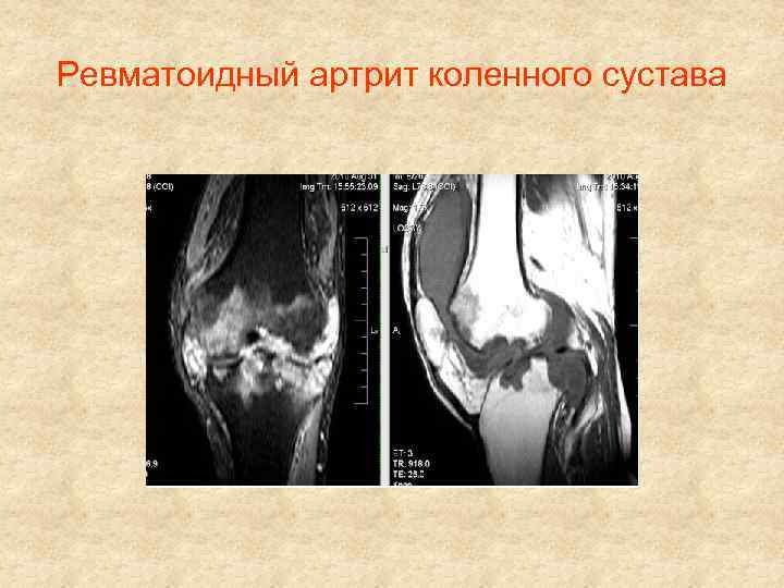 Ревматоидный артрит коленного сустава 