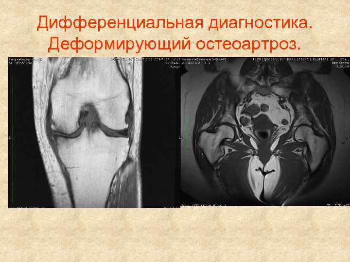 Дифференциальная диагностика. Деформирующий остеоартроз. 