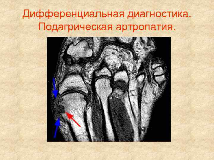 Дифференциальная диагностика. Подагрическая артропатия. 
