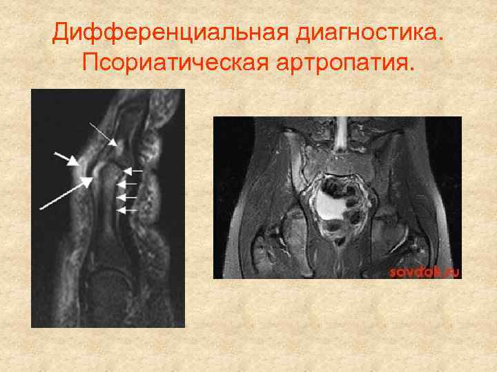 Дифференциальная диагностика. Псориатическая артропатия. 