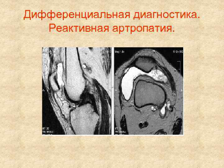 Дифференциальная диагностика. Реактивная артропатия. 