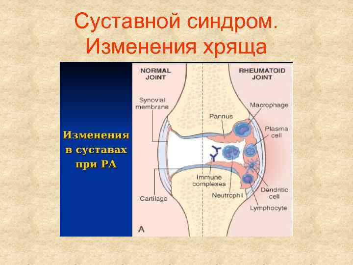 Суставной синдром. Изменения хряща 
