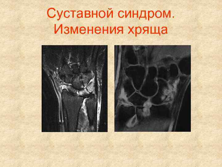 Суставной синдром. Изменения хряща 