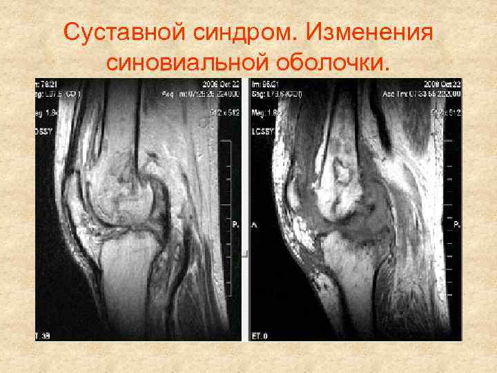 Суставной синдром. Изменения синовиальной оболочки. 