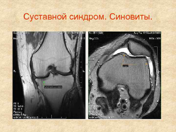 Суставной синдром. Синовиты. 