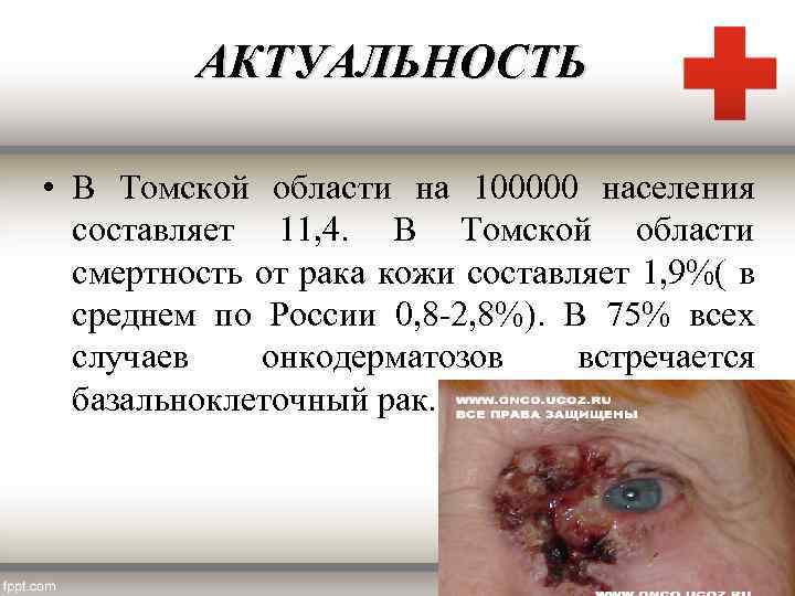 АКТУАЛЬНОСТЬ • В Томской области на 100000 населения составляет 11, 4. В Томской области