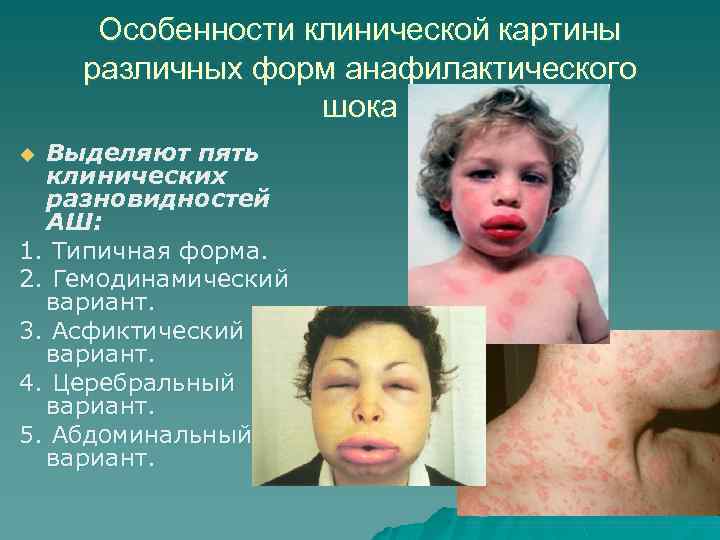 Особенности клинической картины различных форм анафилактического шока Выделяют пять клинических разновидностей АШ: 1. Типичная