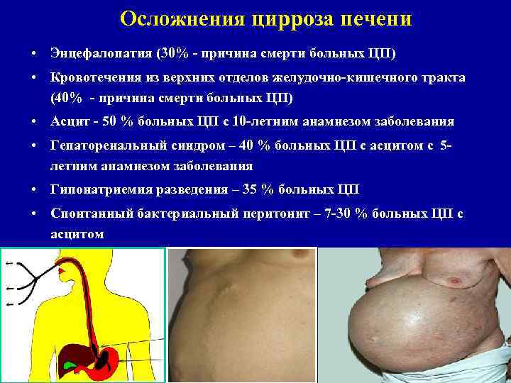 Осложнения цирроза печени • Энцефалопатия (30% - причина смерти больных ЦП) • Кровотечения из