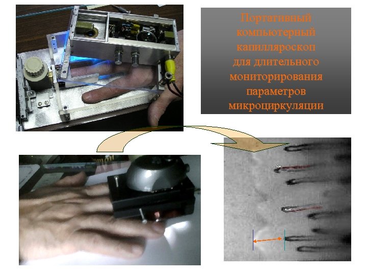 Портативный компьютерный капилляроскоп для длительного мониторирования параметров микроциркуляции 