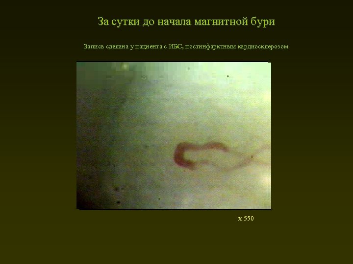 За сутки до начала магнитной бури Запись сделана у пациента с ИБС, постинфарктным кардиосклерозом