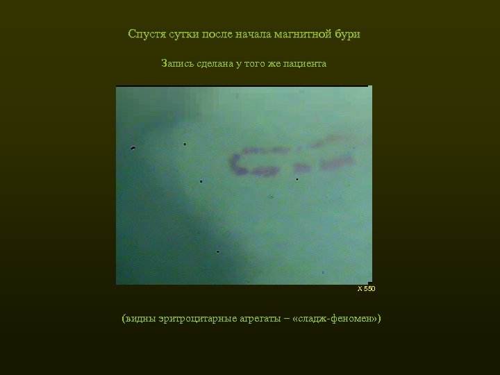 Спустя сутки после начала магнитной бури Запись сделана у того же пациента Х 550