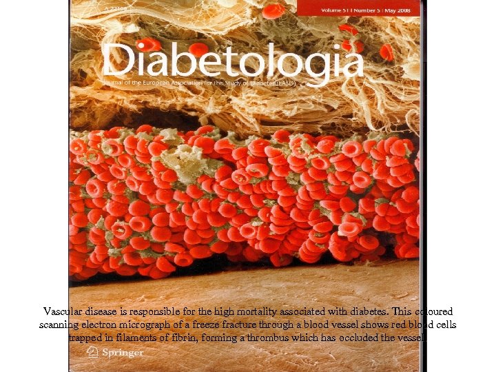 Vascular disease is responsible for the high mortality associated with diabetes. This coloured scanning