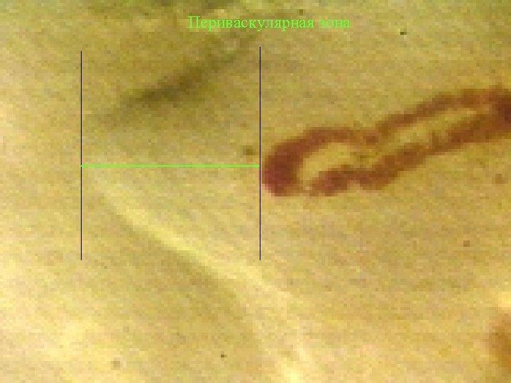 Периваскулярная зона 