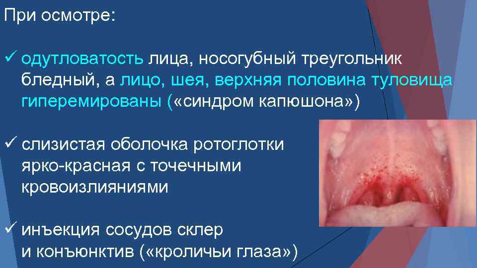 При осмотре: ü одутловатость лица, носогубный треугольник бледный, а лицо, шея, верхняя половина туловища