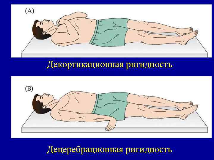 Декортикационная ригидность Децеребрационная ригидность 