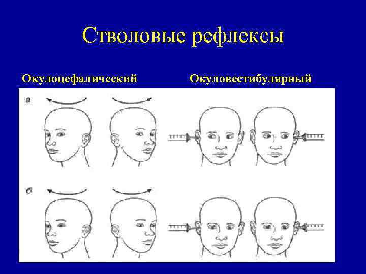 Стволовые рефлексы Окулоцефалический Окуловестибулярный 