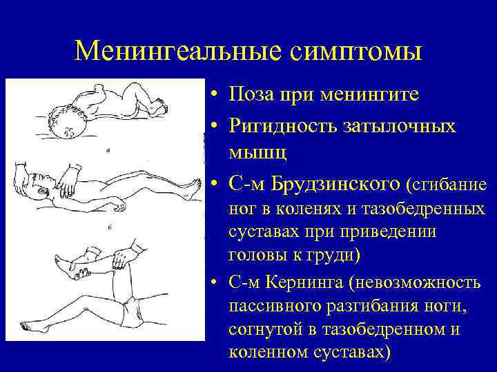 Менингеальные симптомы • Поза при менингите • Ригидность затылочных мышц • С м Брудзинского