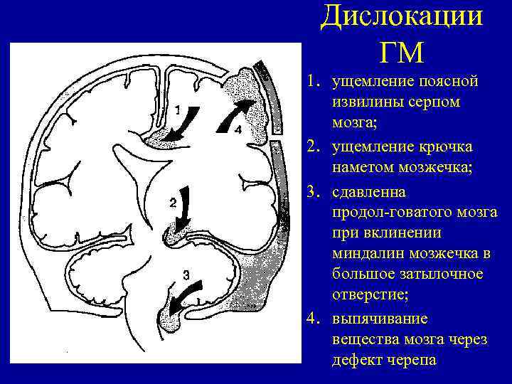 Дислокации ГМ 1. ущемление поясной извилины серпом мозга; 2. ущемление крючка наметом мозжечка; 3.