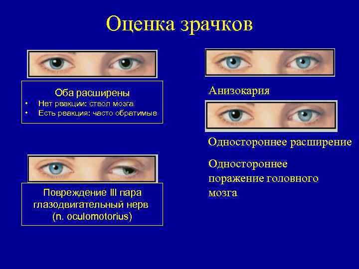 Оценка зрачков Оба расширены • • Анизокария Нет реакции: ствол мозга Есть реакция: часто