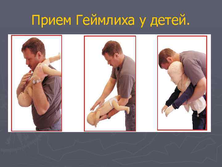 Прием Геймлиха у детей. 