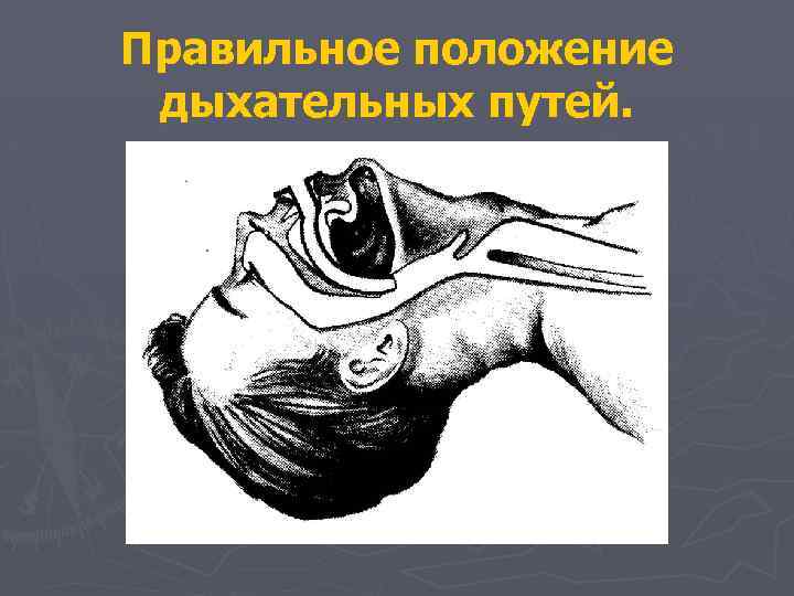Правильное положение дыхательных путей. 