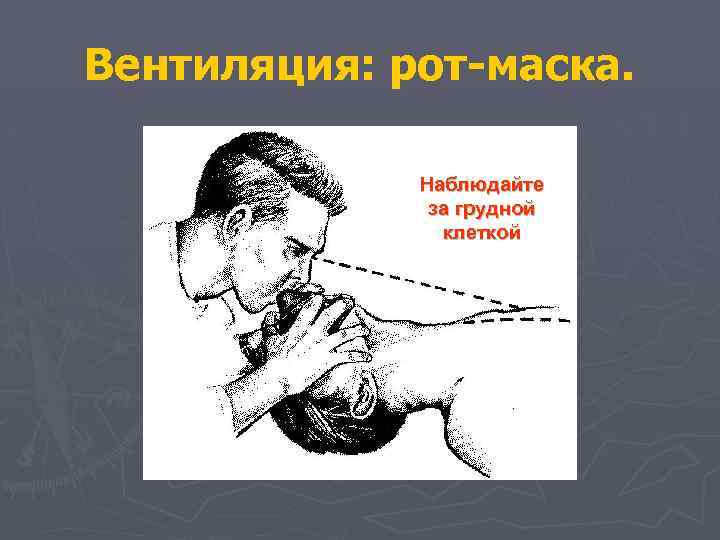 Вентиляция: рот-маска. Наблюдайте за грудной клеткой 