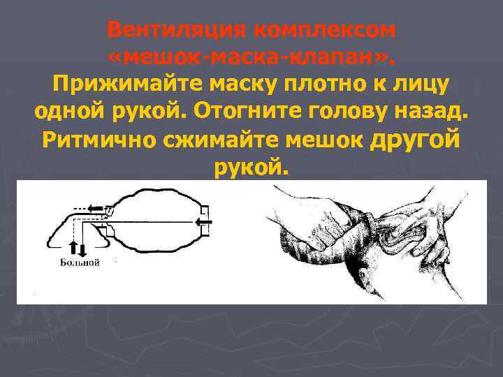 Вентиляция комплексом «мешок-маска-клапан» . Прижимайте маску плотно к лицу одной рукой. Отогните голову назад.